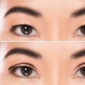 Double Eyelid Surgery: An In-Depth Look