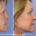 Neck Lifts: A Comprehensive Overview