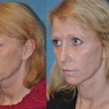 Cheek Lifts: A Comprehensive Overview