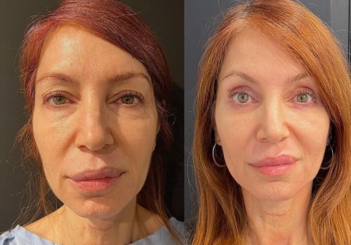 Lower Eyelid Lift: A Comprehensive Overview