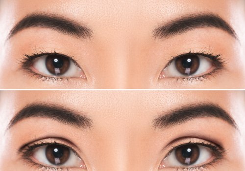 Double Eyelid Surgery: An In-Depth Look