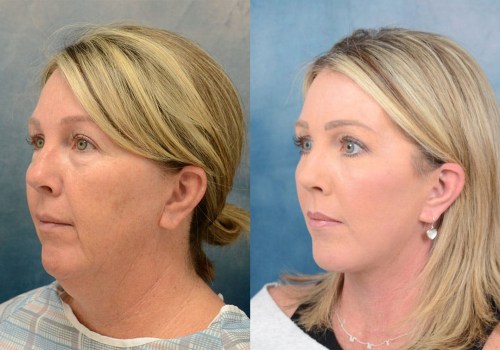 Facelift Surgery: A Comprehensive Overview