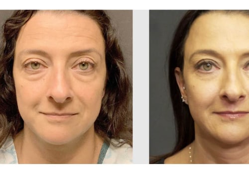 Mid Facelift: What to Know