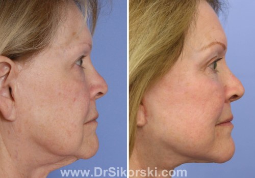 Neck Lifts: A Comprehensive Overview