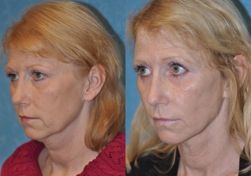 Cheek Lifts: A Comprehensive Overview