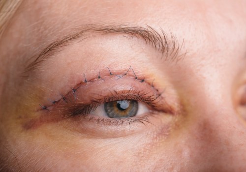 Everything You Need to Know About an Upper Eyelid Lift